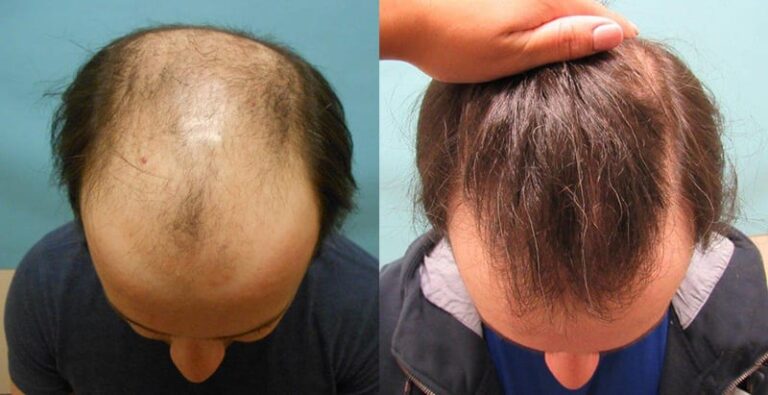 hair transplant surgery in kolkata
