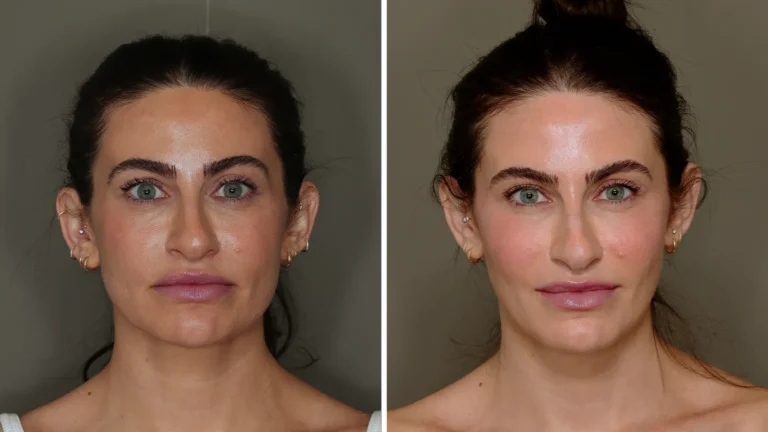 nanofat grafting in kolkata - Plastic Surgeon kolkata